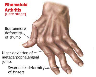 RA Hand 1.png