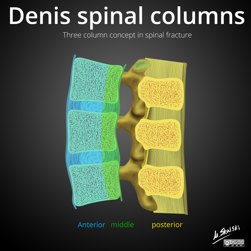 Denis-three-column-concept-in-spinal-fracture.jpg